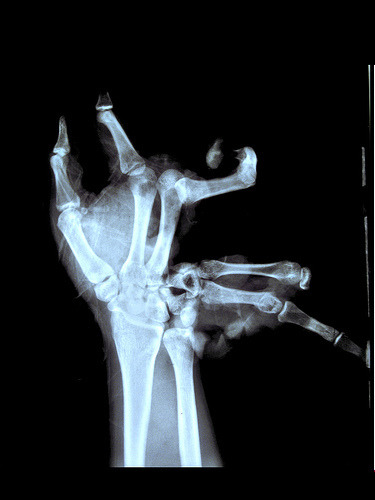 Shit and/or shinola, nostrich: An x-ray of a youth's hand after a lit.