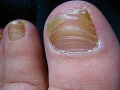 Vicks+vapor+rub+toenail+fungus+treatment