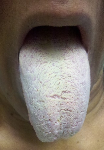 deformutilation: White Furrowed Tongue A 44-year-old woman demonstrates a  white furrowed tongue probably resulting from poor oral hygiene.  Her  tongue improved with regular brushing and generally improved dental care. 